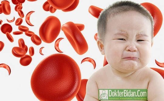 Anemia Sel Sabit Sickle Cell - Penyebab Gejala Pengobatan dan Pencegahanya Anemia Sel Sabit Sickle Cell - Penyebab Gejala Pengobatan dan Pencegahanya