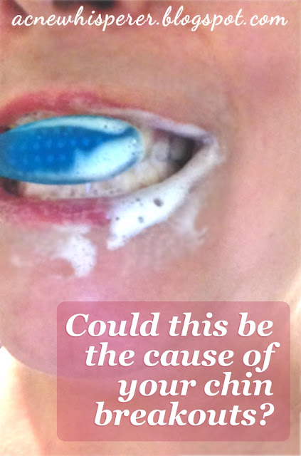 Chin breakouts caused by over-exposure to foaming agents in toothpaste.