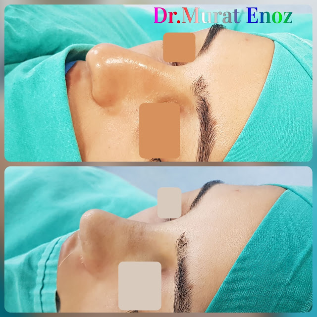thick skinned nose aesthetic, nose job for women, rhinoplasty operation in istanbul, femal nose job, ethnic rhinoplasty, nose job for thick skinned nose, rhinoplasty in istanbul