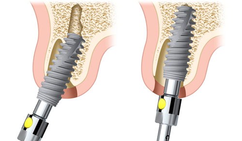 TIÊU CHÍ LỰA CHỌN TRỤ IMPLANT TỐT VÀ PHÙ HỢP NHẤT -4