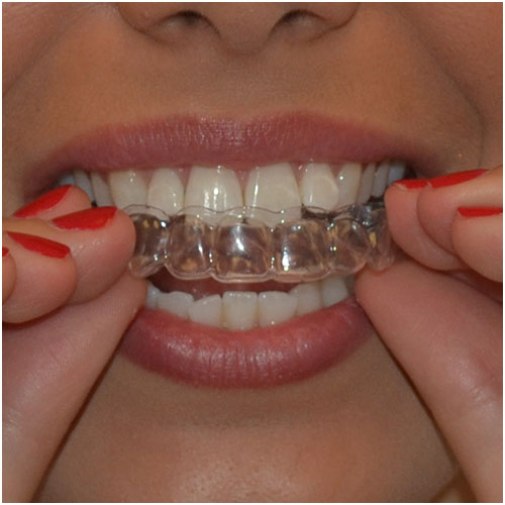 teeth whitening trays tooth dental mouth gel guard braces whitener whiten bleaching moldable oral paint tray brush remove zoom emessa