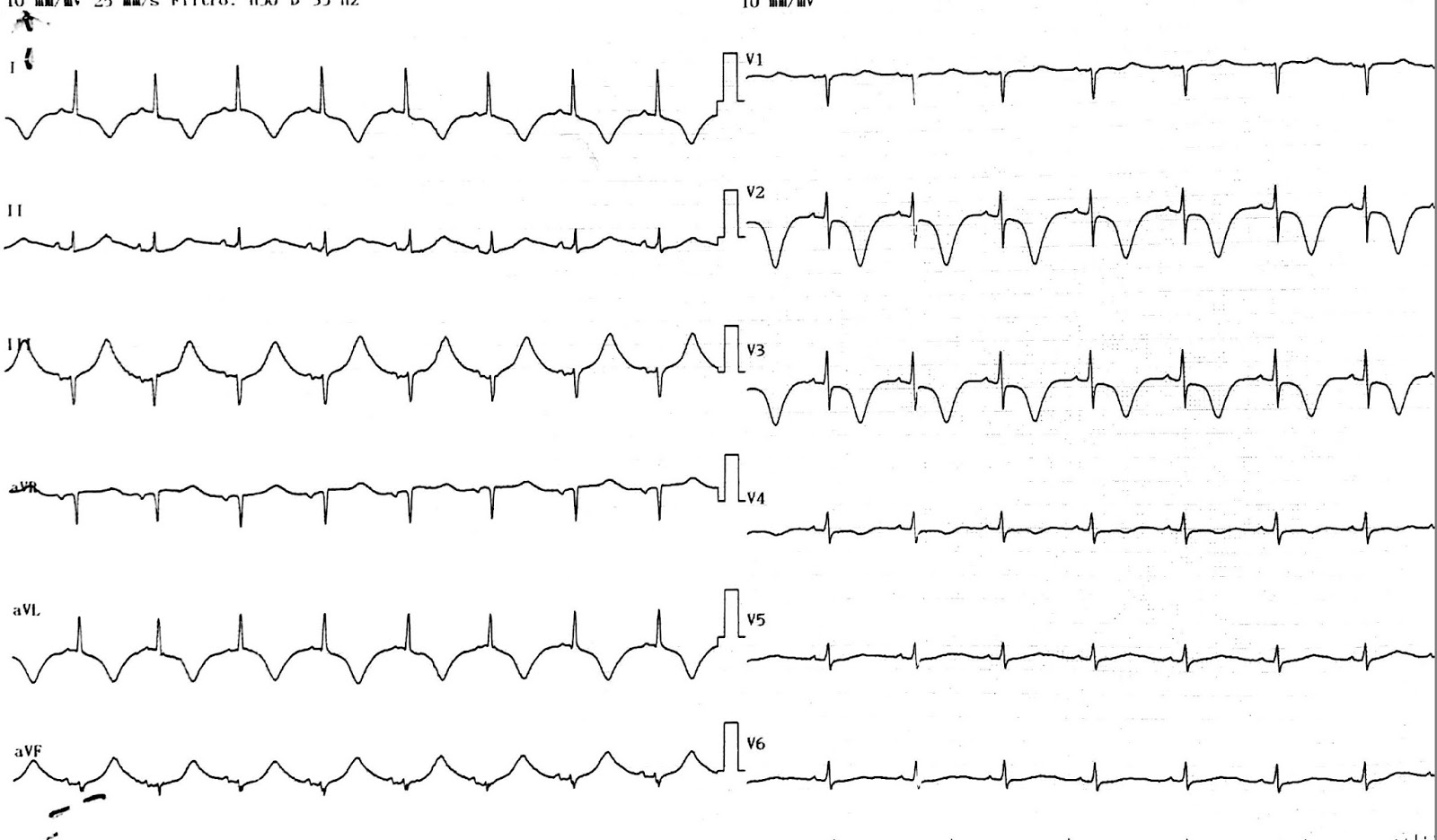 Dr. Smith's ECG Blog Chest pain and Inferior Twave Inversion. Does