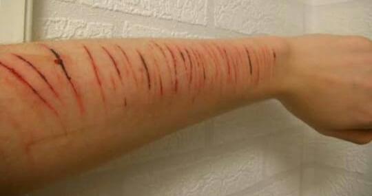 الكاتينج بداية الطريق للانتحار