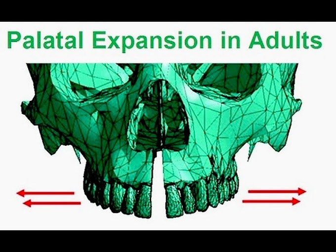 PALATAL EXPANSION: Is Possible In Adults - Dr Mike Mew