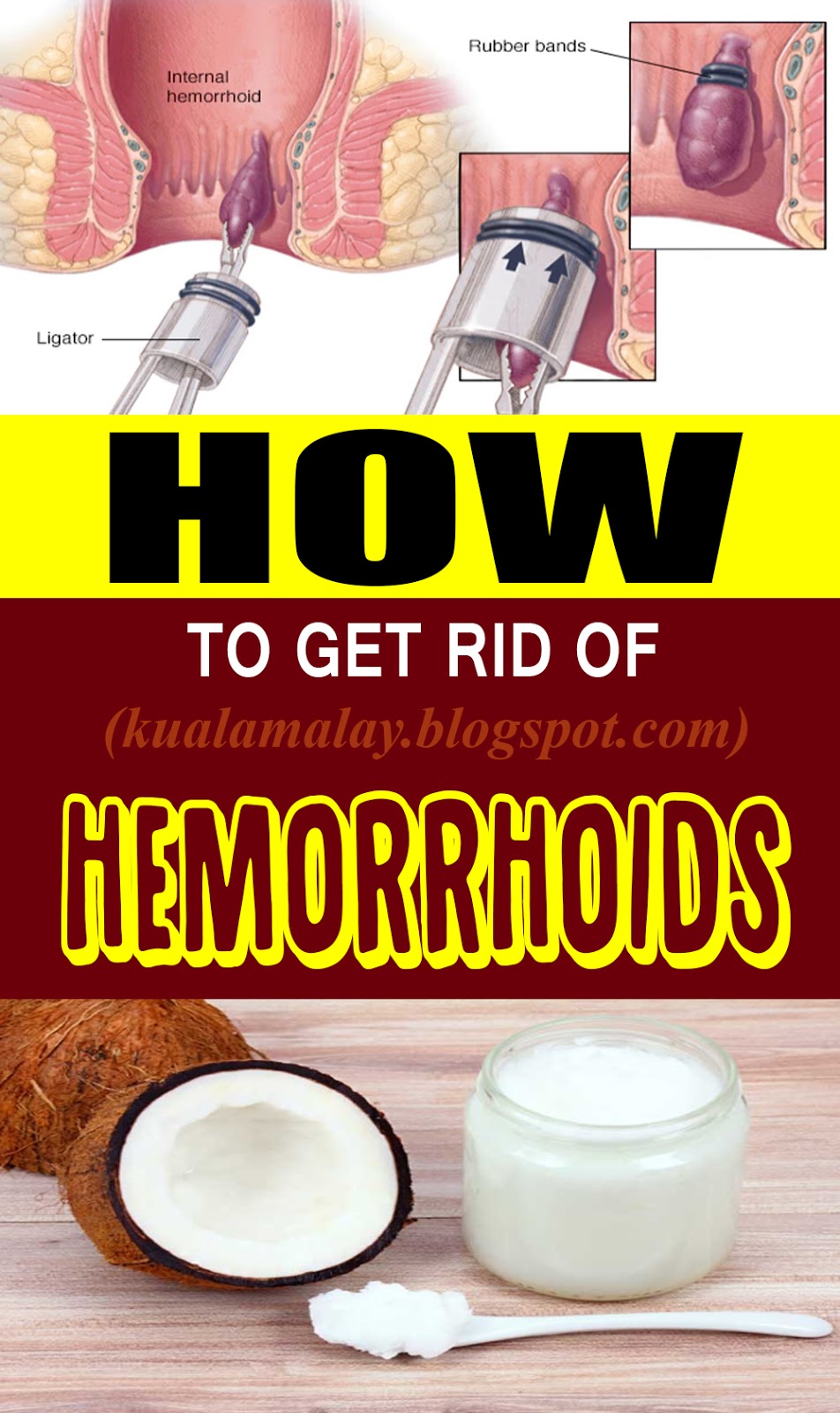 How To Get Rid Of Hemorrhoids Without Surgery
