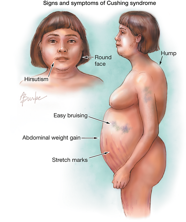 cushing syndrome อาการ images