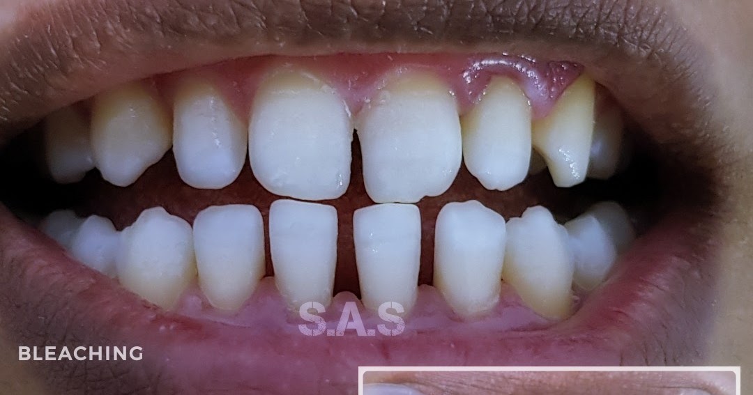 Harga Bleaching Gigi Di Jember Terbaru