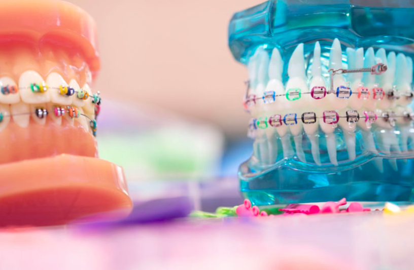 Steps Followed For The Best Orthodontic treatment Process At Growing Smiles