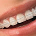 Niềng răng sứ bao lâu phụ thuộc vào yếu tố nào