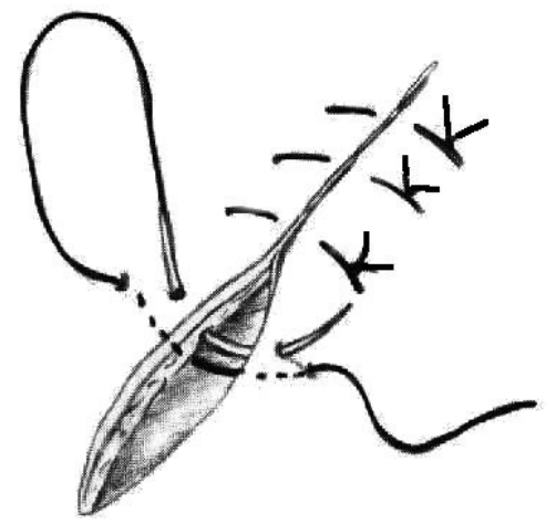 DONATTI  Empregada em sutura cuticular, é particularmente útil em  àreas onde há possibilidade de se instalar edema.  É útil também quando se espera que haverá aumento da  pressão interna de uma cavidade (ex.:timpanismo) que irá  pressionar a parede abdominal suturada. 
