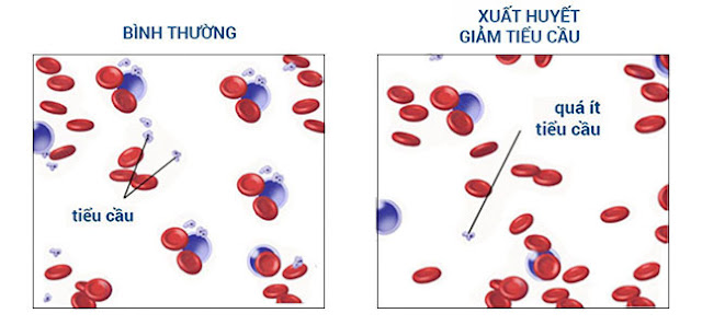 ban xuat huyet giam tieu cau