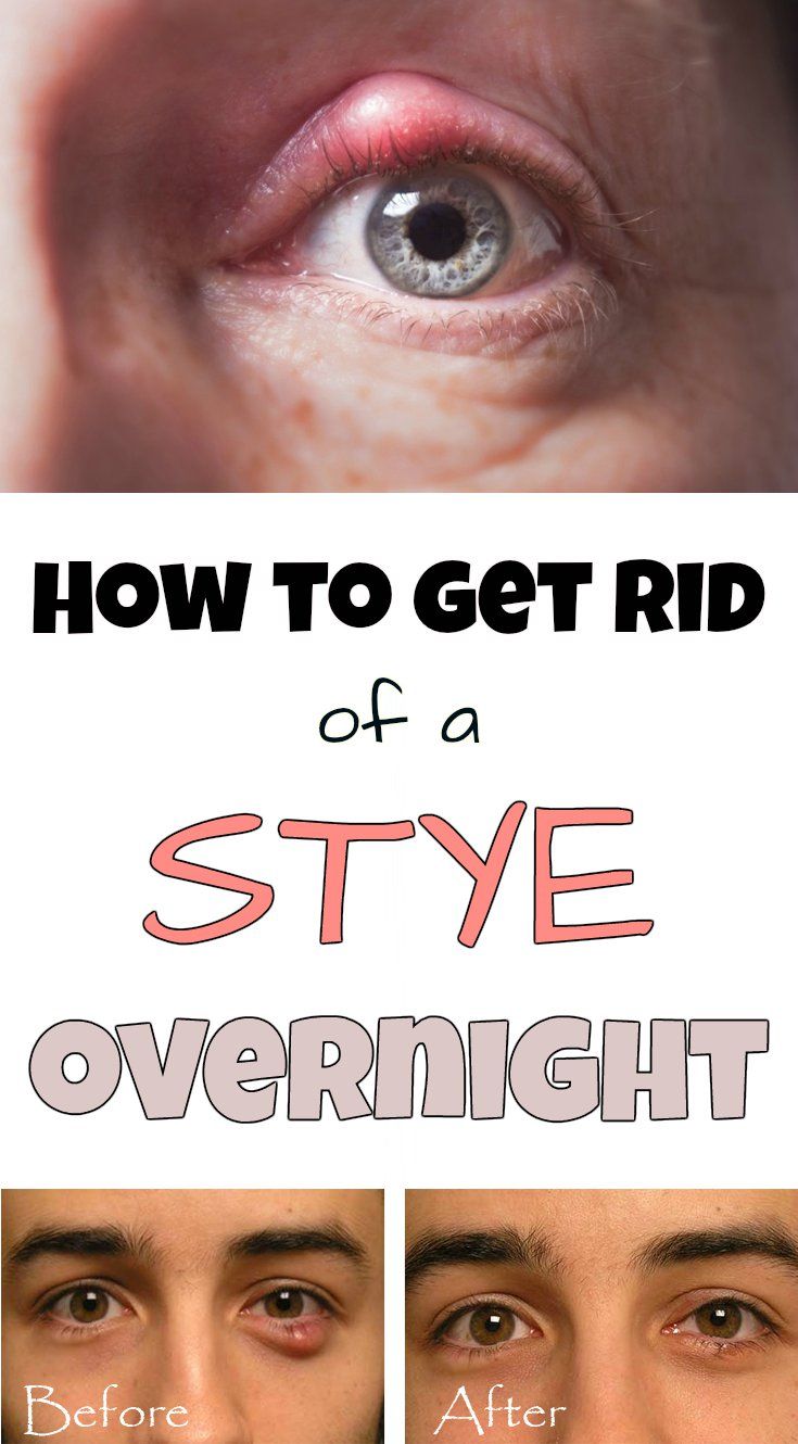How To Get Rid Of a Stye Overnight Healthy Planning