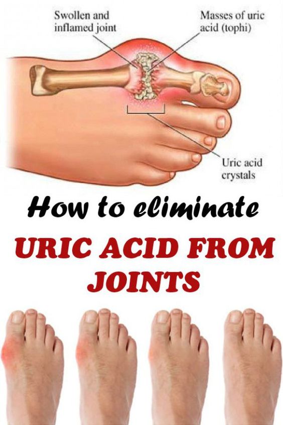 How To Eliminate Uric Acid From Joint wellness magazine