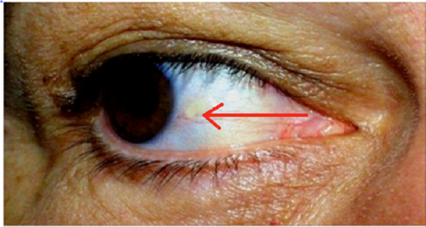 SUS OJOS PUEDE INDICAR SI ESTÁ A PUNTO DE SUFRIR UN ACCIDENTE CEREBROVASCULAR SUS OJOS PUEDE INDICAR SI ESTÁ A PUNTO DE SUFRIR UN ACCIDENTE CEREBROVASCULAR
