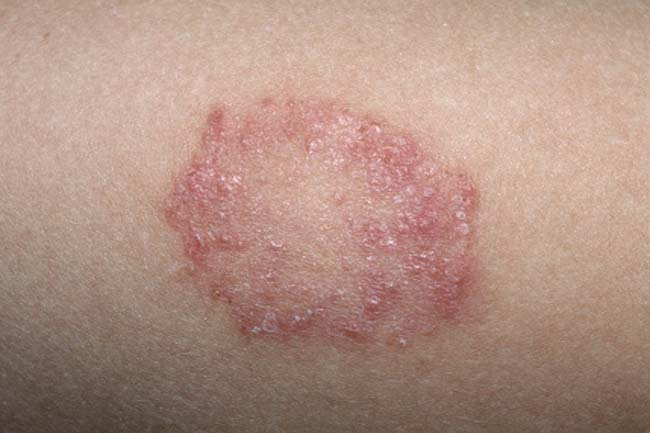 Penyakit Jamur di Kulit