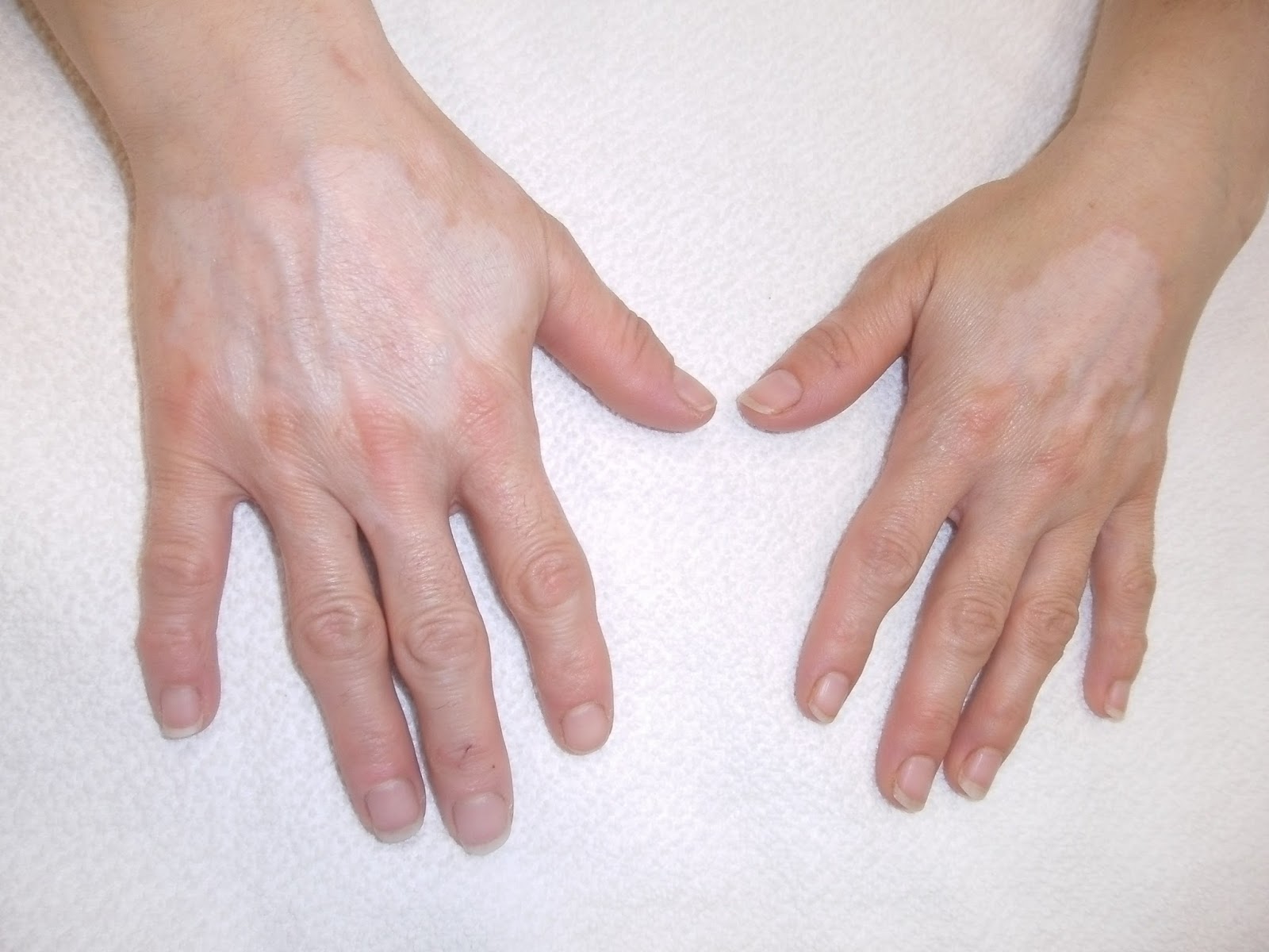 Rheumatologe Vitiligo in a Patient with Rheumatoid Arthritis under