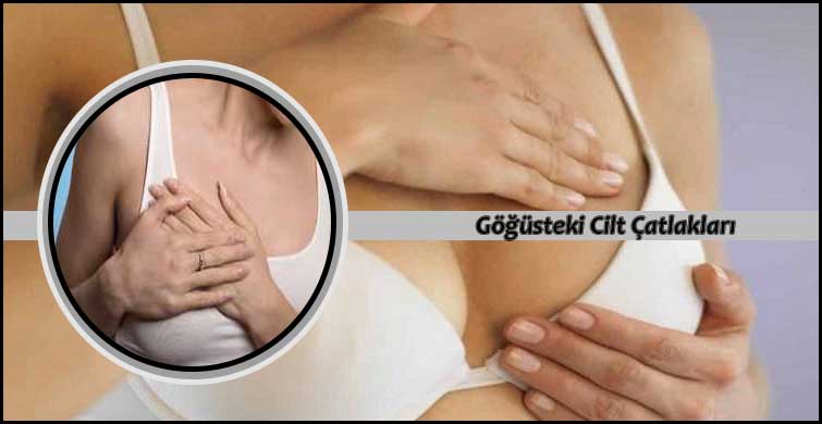 gogusteki cilt catlaklari catlak mi