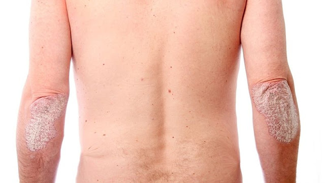 ما هي أسباب التنيا الملونة؟ ما هي أسباب التنيا الملونة؟