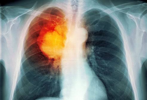 What is the Prognosis of Lung Cancer