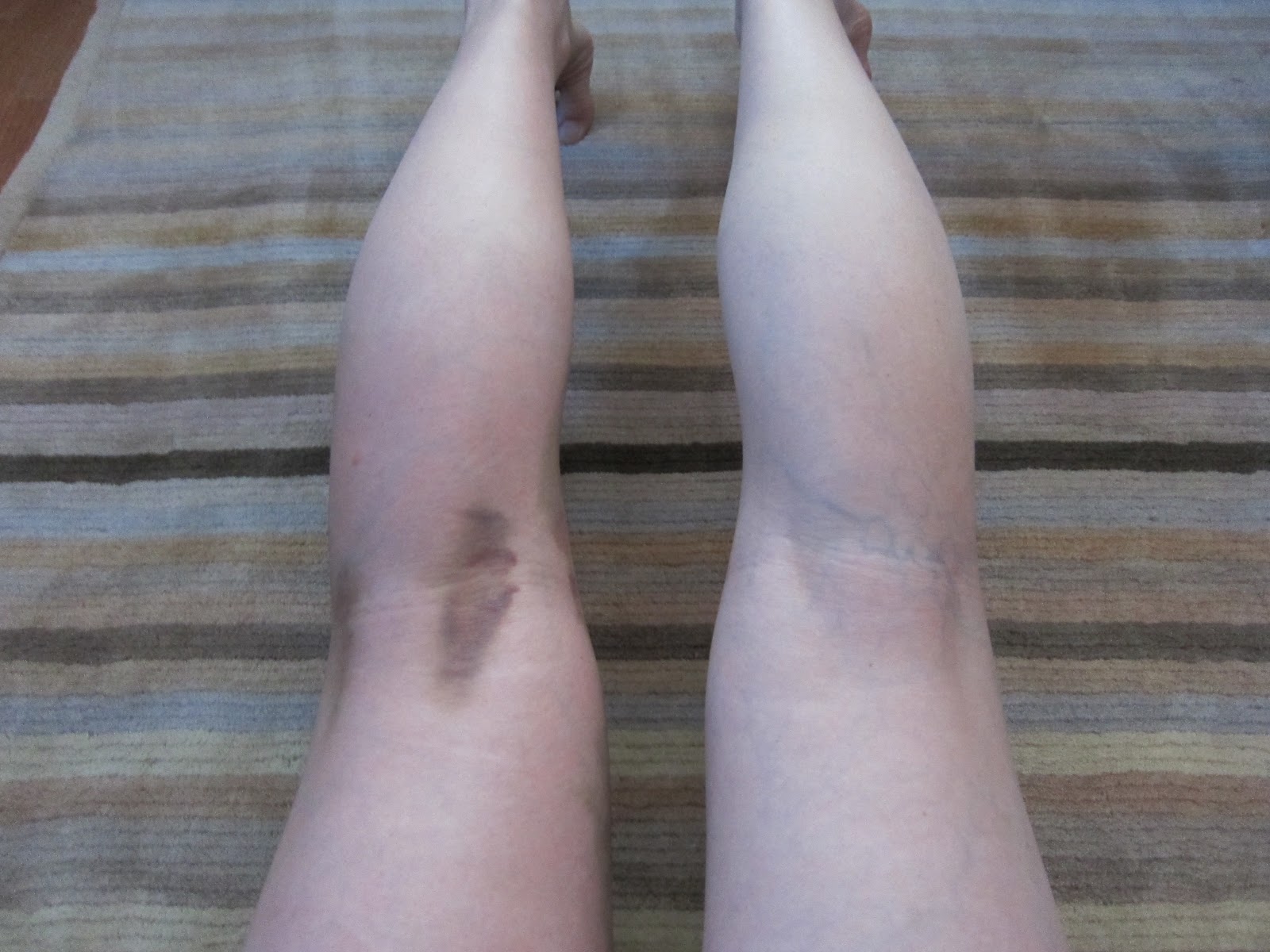 'Knee'd to Know Basis My Personal Experience of ACL Tear