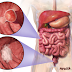 Understanding Colon and Rectal Cancer
