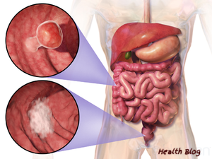 Understanding Colon and Rectal Cancer - Health Blog