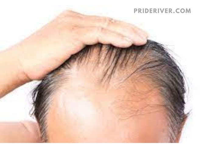 Medical reasons for hair loss | part-1