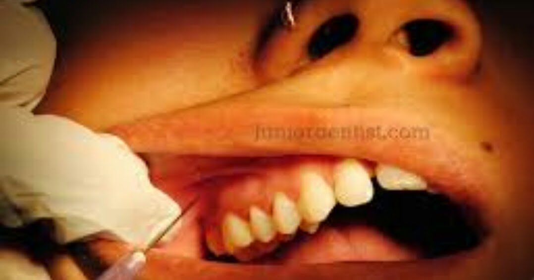 MAXILLARY ANESTHESIA TECHNIQUES