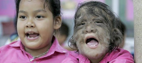16 niños estan sufriendo el sindrome del hombre lobo en europa. 16 niños estan sufriendo el sindrome del hombre lobo en europa.