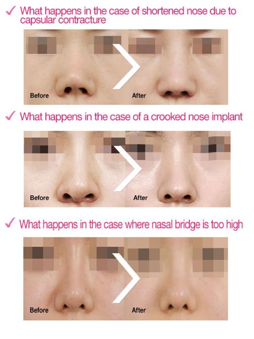 ID Hospital Korea How to get a natural nose surgery that does not