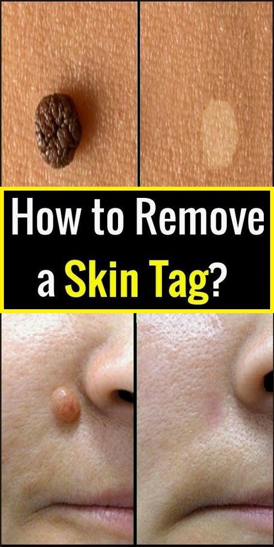 How to Remove a Skin Tag?