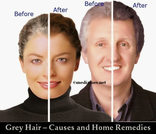 Grey Hair Causes and Home Remedies