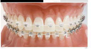 Quy trình niềng răng móm tại nha khoa-2