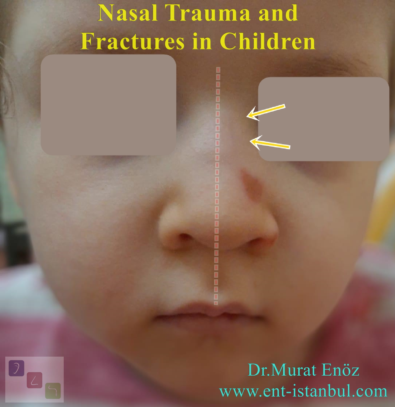 Nasal Fractures Causes, Symptoms, Diagnosis, Treatment
