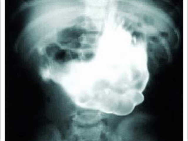 Radiografías de objetos en el estómago