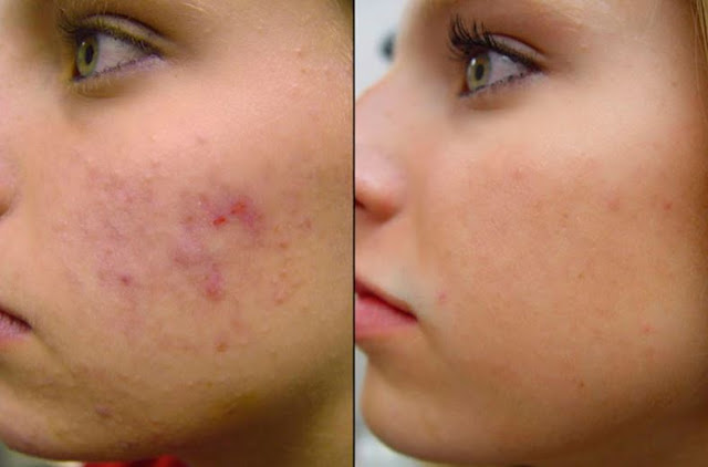 Acne Treatment from the inside out
