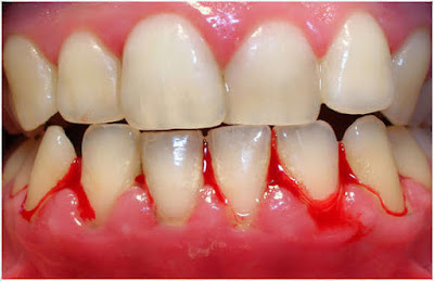 Bleeding gums, Gingivitis | Gum bleeding causes| treatment