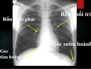 Hướng dẫn đọc X quang ngực cơ bản