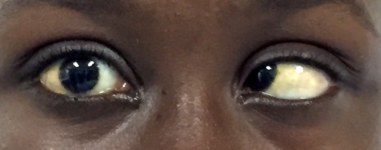 Yoos And Eyes In Zambia December 2015