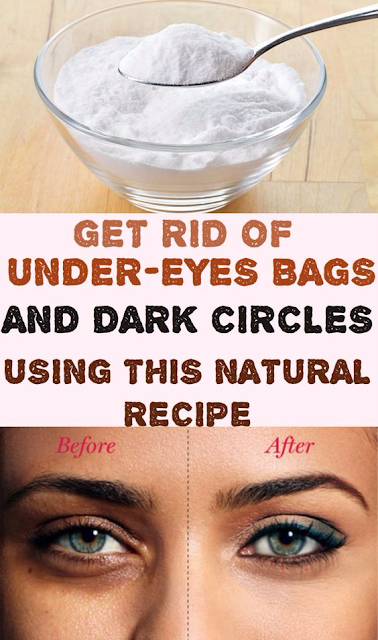 Get Rid of Under-Eyes Bags and Dark Circles Using This Natural Recipe