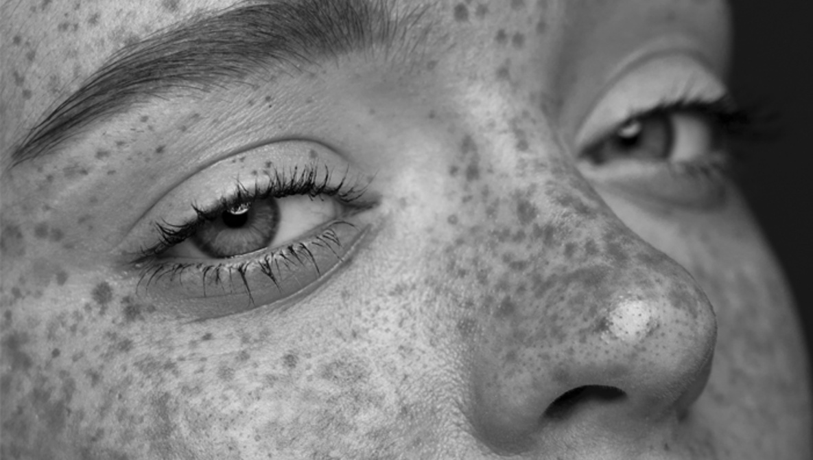 ciltte siyah lekeler neden olur siyah