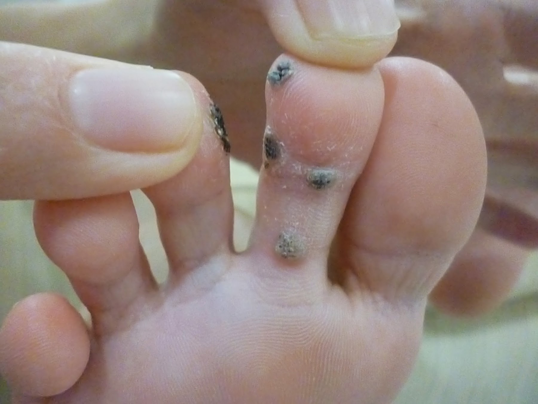 Fresh 80 of Planters Warts On Toes calidademocional