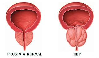 tratamentul prostatei cu remedii populare)