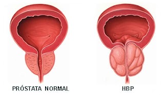 prostatita cronica tratament formula as forum lumanari pentru prostatita