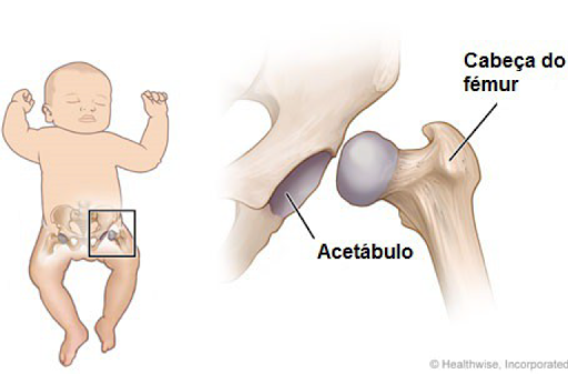 O que é a Displasia da Anca do Desenvolvimento?
