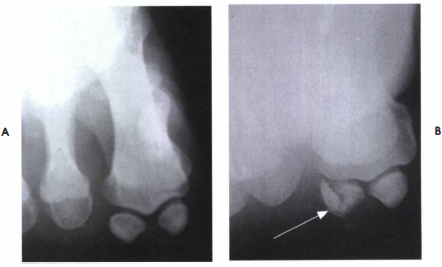 TANGENTIAL PROJECTION: TOES-SESAMOIDS - RadTechOnDuty