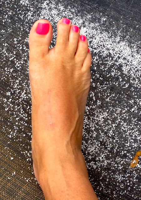 After LisFranc Surgery