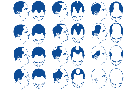 ¿Qué es la alopecia androgénica?