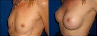 augmentation mammaire femme avant et après