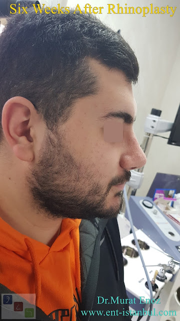 Male nose job Turkey. Nose aesthetic surgery for men,Rhinoplasty in Men Istanbul,